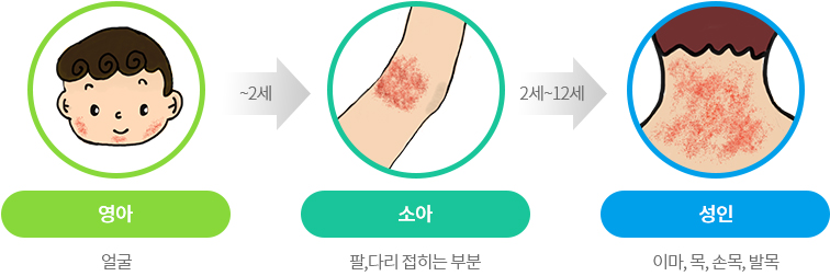 연령에 따른 발생부위 변화 이미지